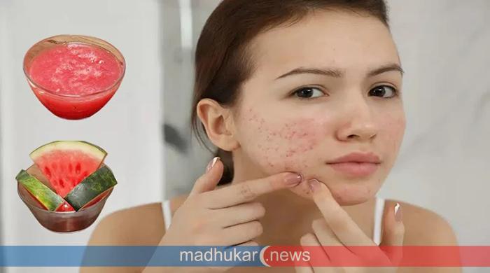 তরমুজ দিয়ে দূর করুন ত্বকের বিভিন্ন সমস্যা