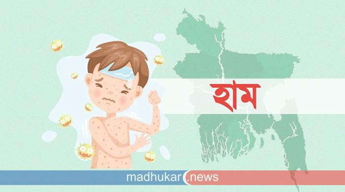 দেশে হামের ভয়াবহ প্রাদুর্ভাব: দেড় মাসে প্রাণ হারালো আড়াই শতাধিক শিশু